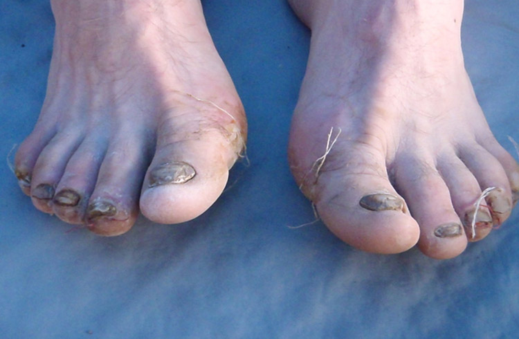 Disgusting feet photo