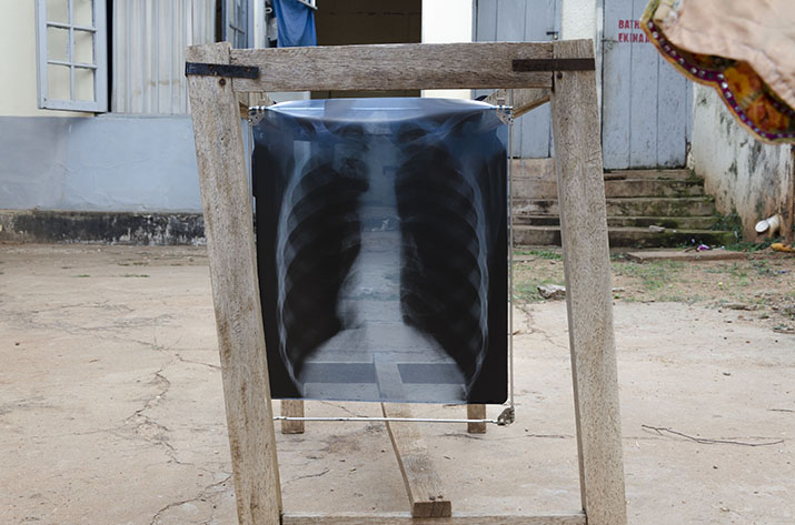 A man with HIV was taken to a private clinic funded by TUSC supporters. This is an image of his X-ray drying, unclear and not accepted by many other of the country's hospitals because they don't provide reliable grounds for diagnosis. He died a few weeks later.